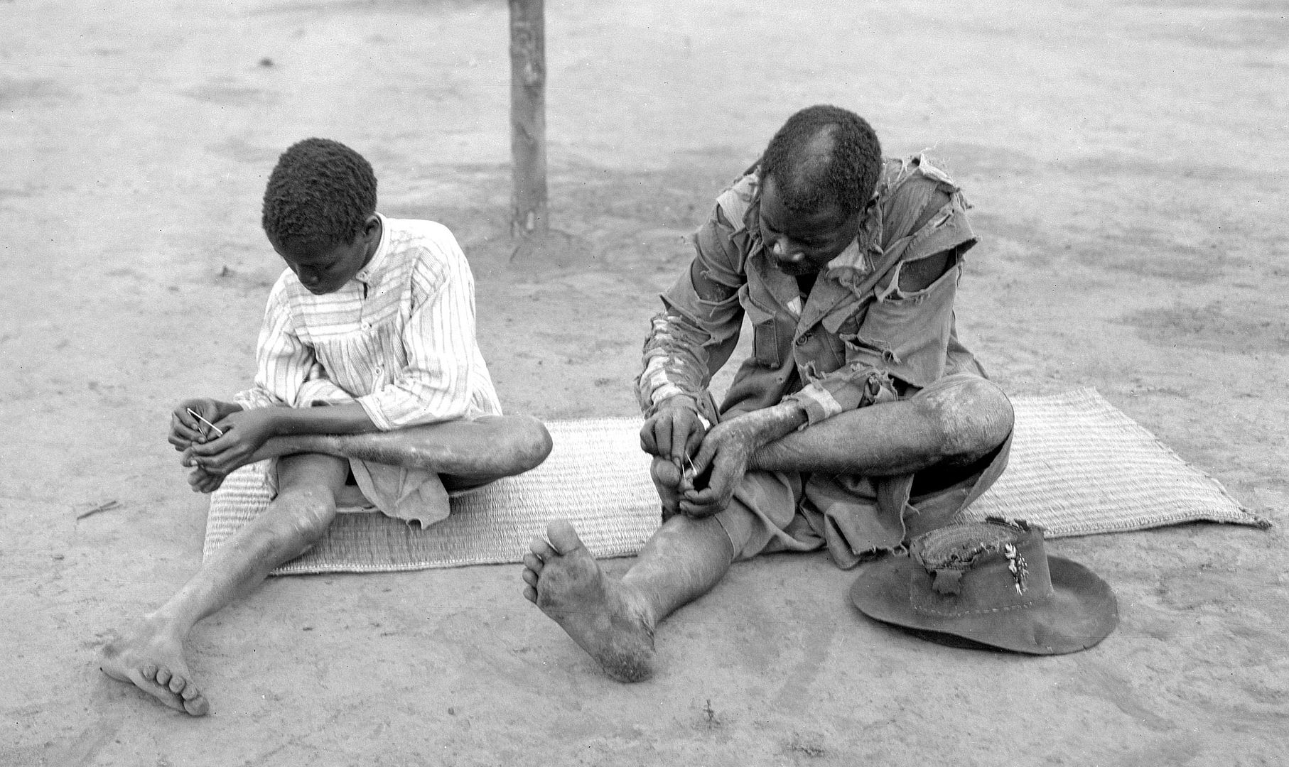 Medical Taking Out Jiggers (matacanas) With Shards Of Glass Photo by